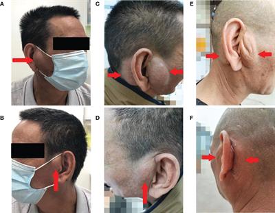 Successful treatment of dupilumab in Kimura disease independent of IgE: A case report with literature review